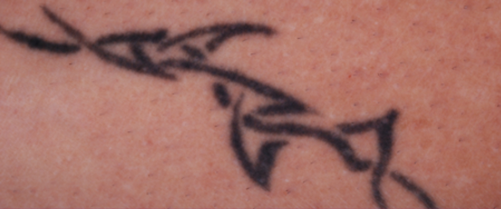 best tattoo removal melbourne